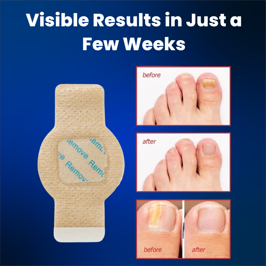 Elaimei® Fungal Nail Patches